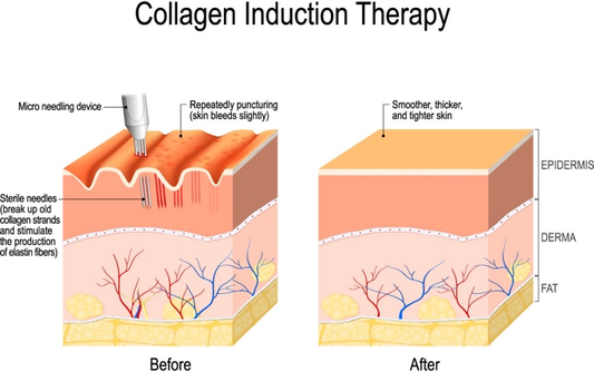 collagen induction therapy