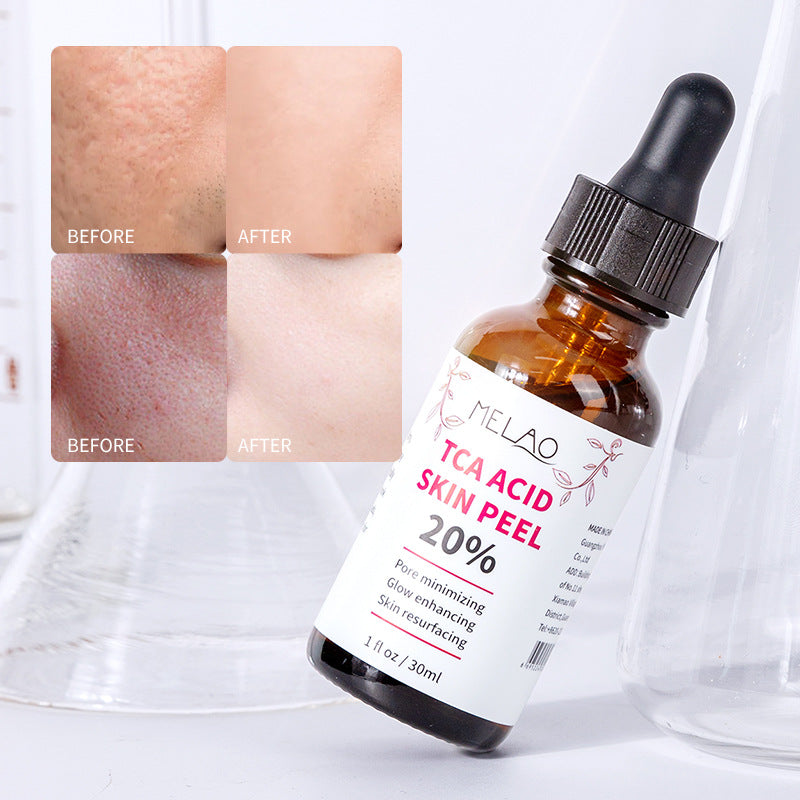 TCA ACID Skin Peel Serum 20%