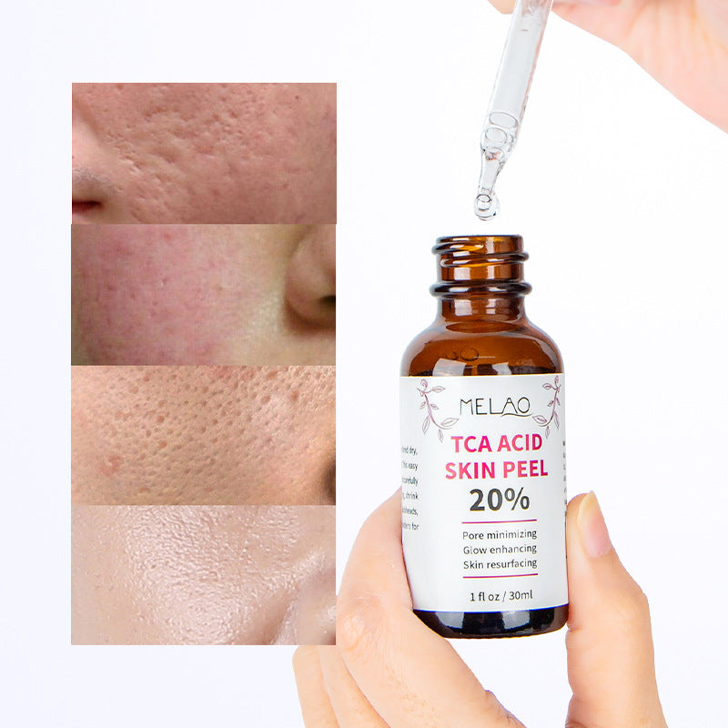 TCA ACID Skin Peel Serum 20%